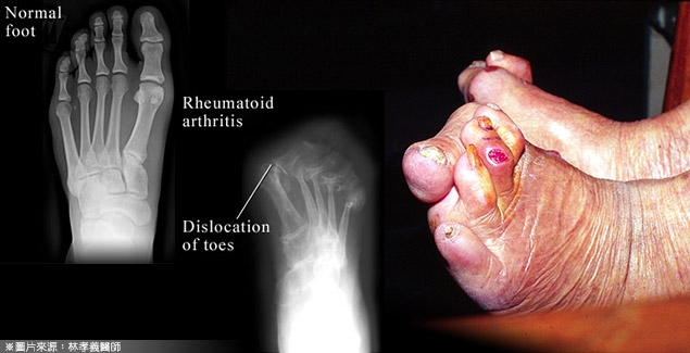 残障的元凶－类风湿性关节炎
