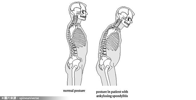 不可忽视的腰酸背痛－ 僵直性嵴椎炎