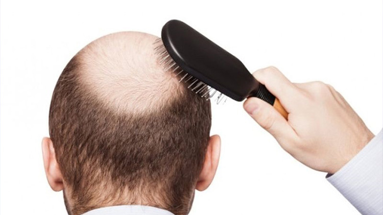 稀疏的頭髮怎麼辦？　靠這招解決您的問題