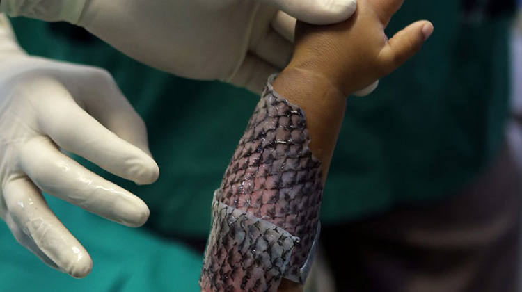 巴西医生使用鱼皮为烧伤患者进行治疗
