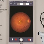 基于智能手机的视网膜成像携手人工智能，支持对视网膜病变进行高度灵敏的自动化早期检测