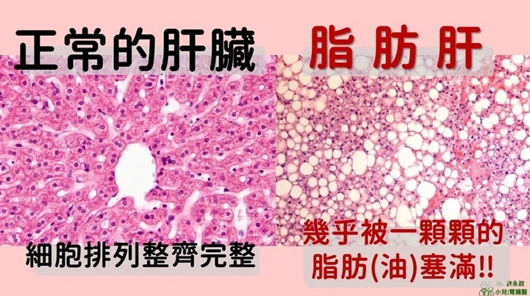 1/5的肥胖兒童有脂肪肝！小心你家孩子肝指數能異常