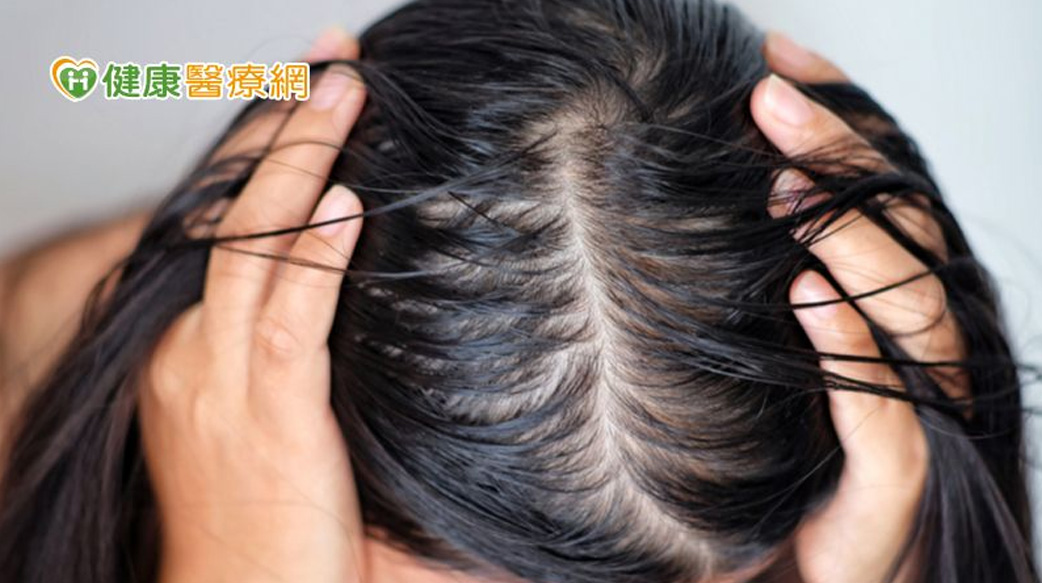 頭皮狂出油？　當心越洗越油，越洗越掉髮