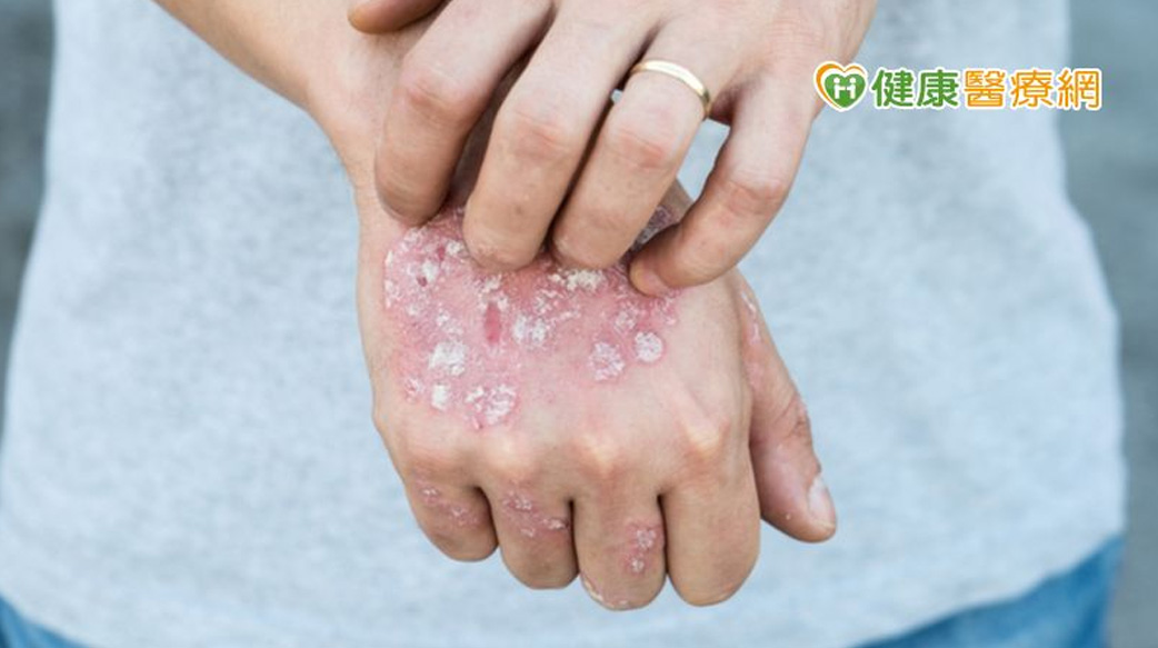 乾癬停藥易復發　健保新增「2年期滿續用」條款