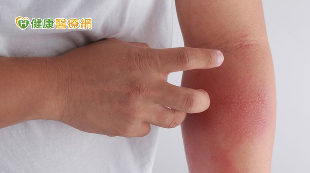 疫情引憂心！異位性皮膚炎能施打新冠疫苗嗎？