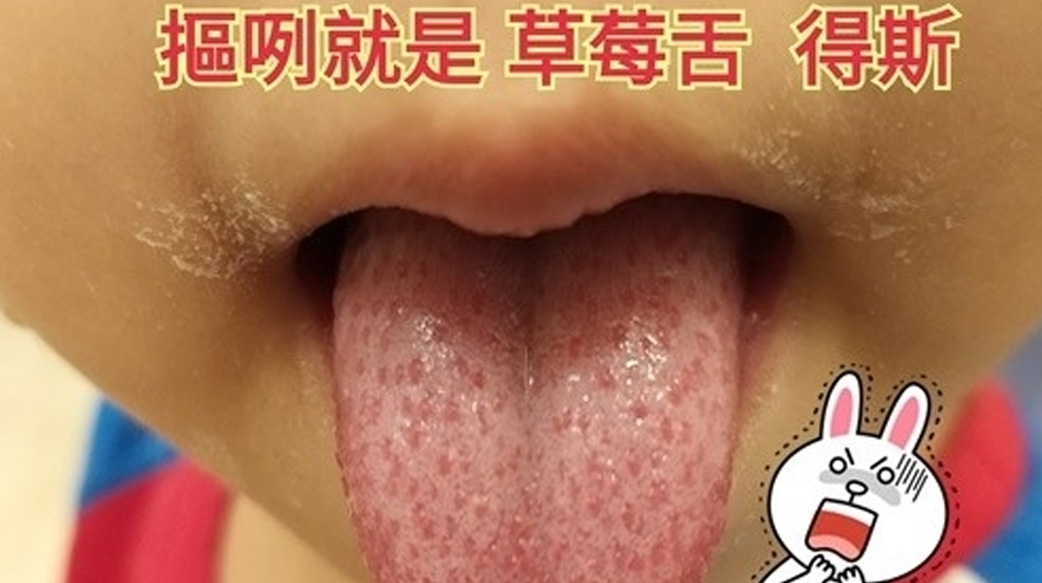 疫情期間哪種狀況要就醫？發燒 + 草莓舌，危險徵兆快就醫！