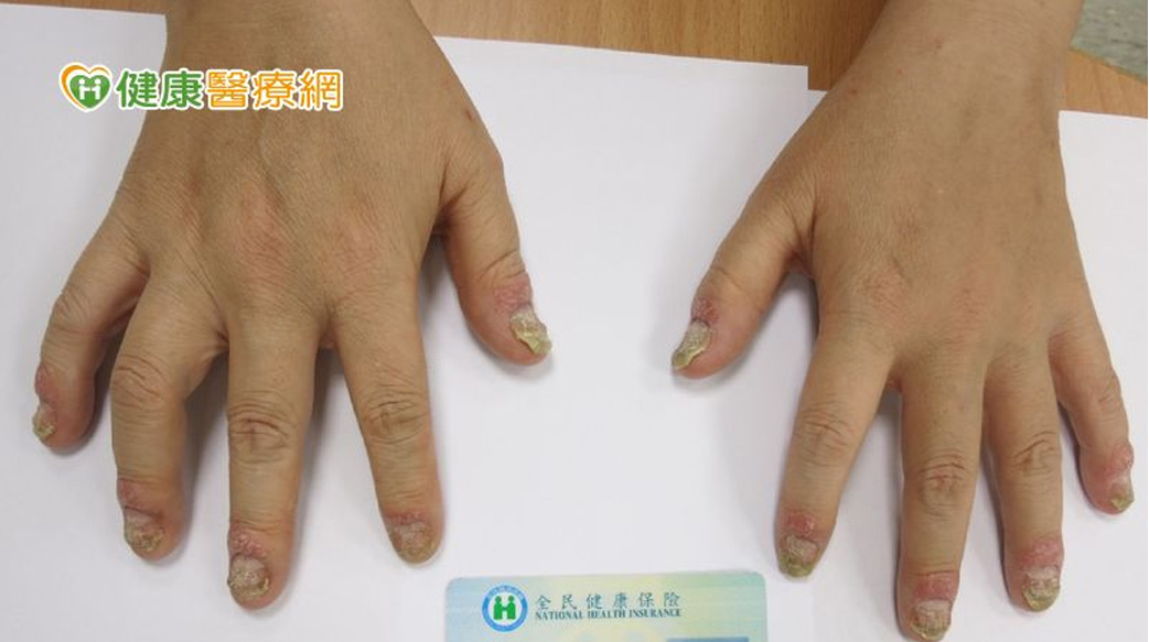 乾癬病友防關節炎小撇步　五大症狀要注意