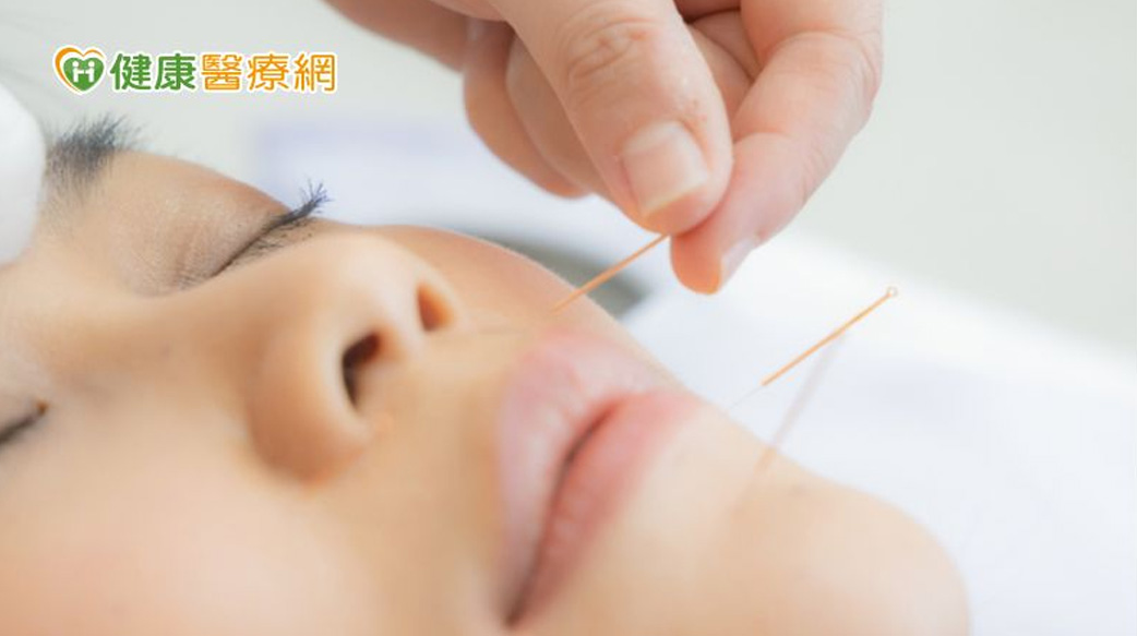 針灸改善臉部水腫　調節水氣助代謝