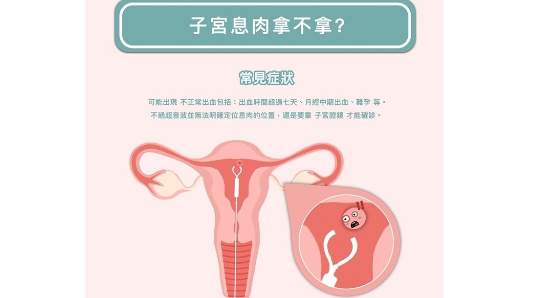 等孕絆腳石！子宮息肉拿不拿?