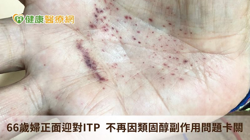 66歲婦正面迎對ITP　不再因類固醇副作用問題卡關