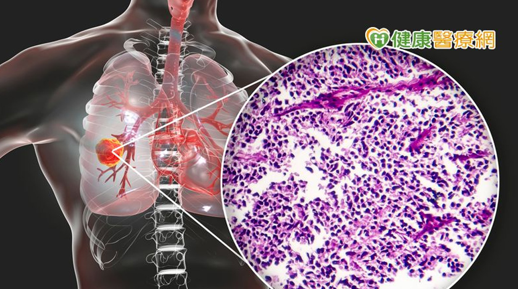 曾1個月內全身佈滿腫瘤　小細胞肺癌患者靠「這個」延命