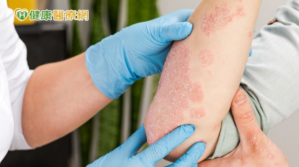 乾癬症狀越顧越遭？ 治療3大關鍵報你知