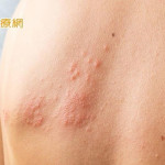 小心！皮蛇上身　新生兒也會被傳染　保護自己超前佈署