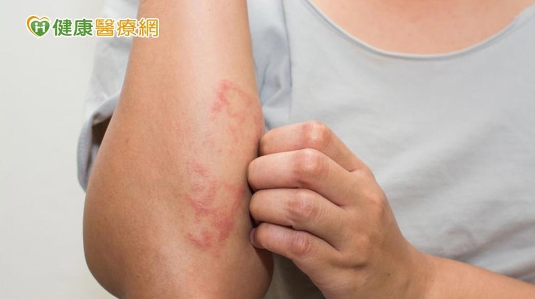 癢到受不了！異位性皮膚炎愈早開始治療愈好！！