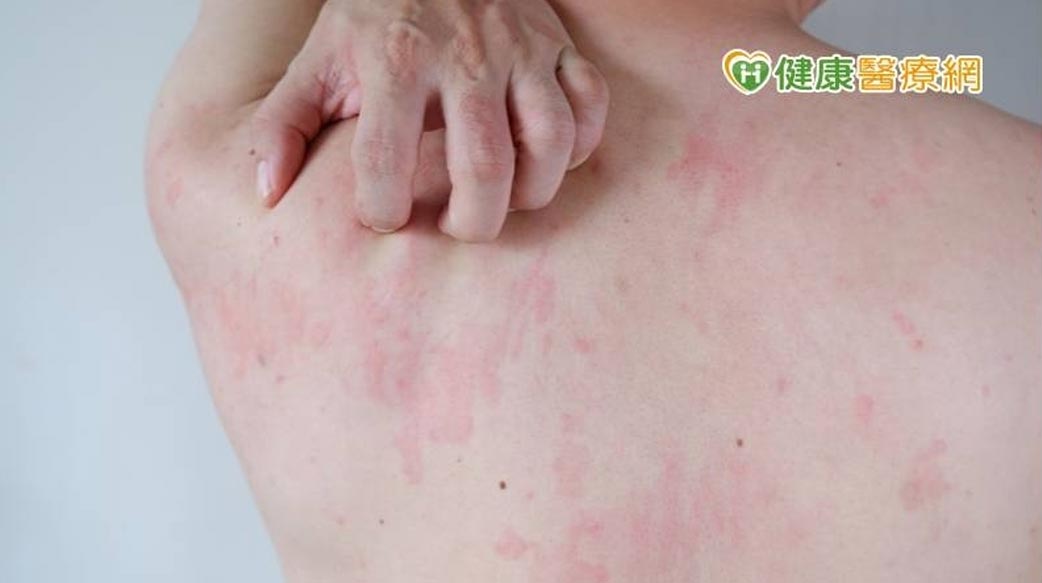 長新冠後遺症可能產生「蕁麻疹」　隨意停藥恐變成慢性癢不停
