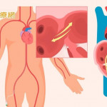 三成中風患者恐二度中風！不明原因中風需警覺　恐為卵圓孔未閉合