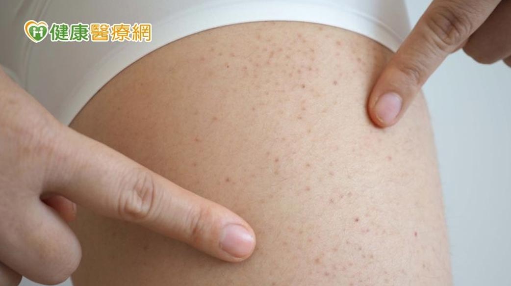 空姐罹病嚴重出血　再生不良性貧血如何覓得生機？