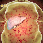 脂肪肝「照超音波看起來油油的」　四旬男肝指數飆破2百