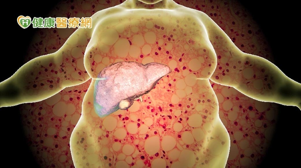 脂肪肝「照超音波看起來油油的」　四旬男肝指數飆破2百