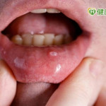 嘴破不一定是火氣大！口腔癌前病變5大症狀　1男輕忽住院天數多6倍