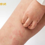 12歲男童罹白血病　又陷移植物抗宿主疾病