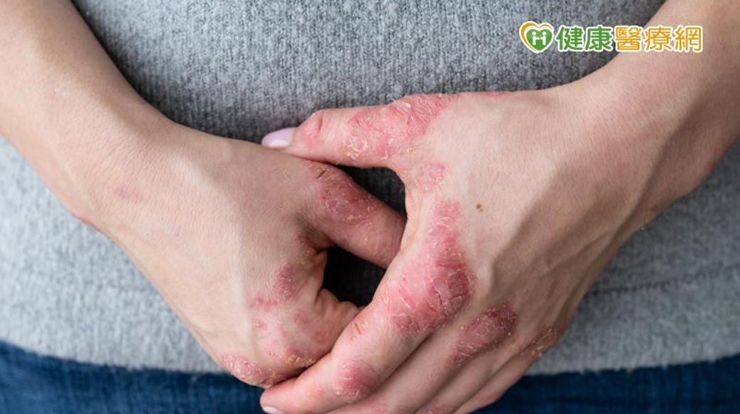 老師總是穿長袖、被誤認傳染病　乾癬性關節炎把握366原則