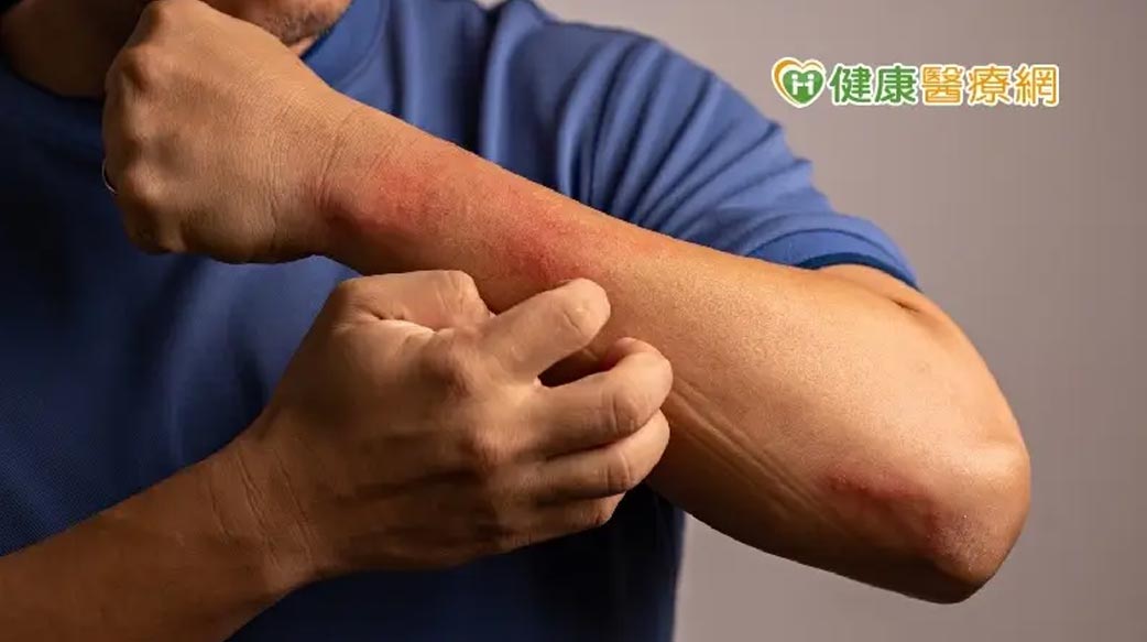 夏日危肌／摸到檸檬柚子起紅疹、皮膚大片變黑！　竟然是對光敏感