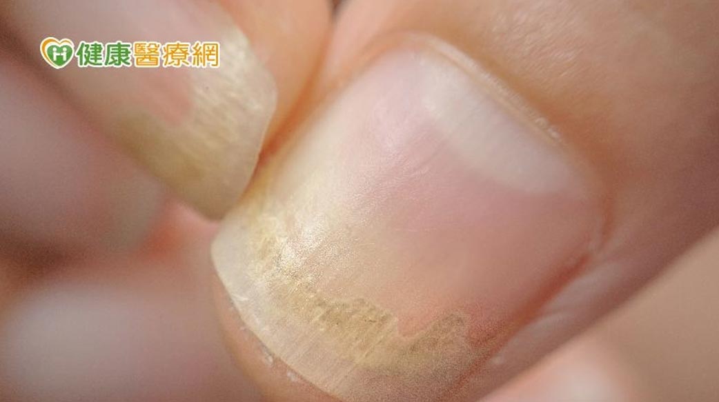 指甲變色、變厚、變形不一定是灰指甲！　「這些」都可能產生指甲症狀