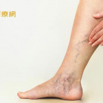 「這些人」易有靜脈曲張　如何預防、緩解症狀？醫師傳授抬腳、按摩方法