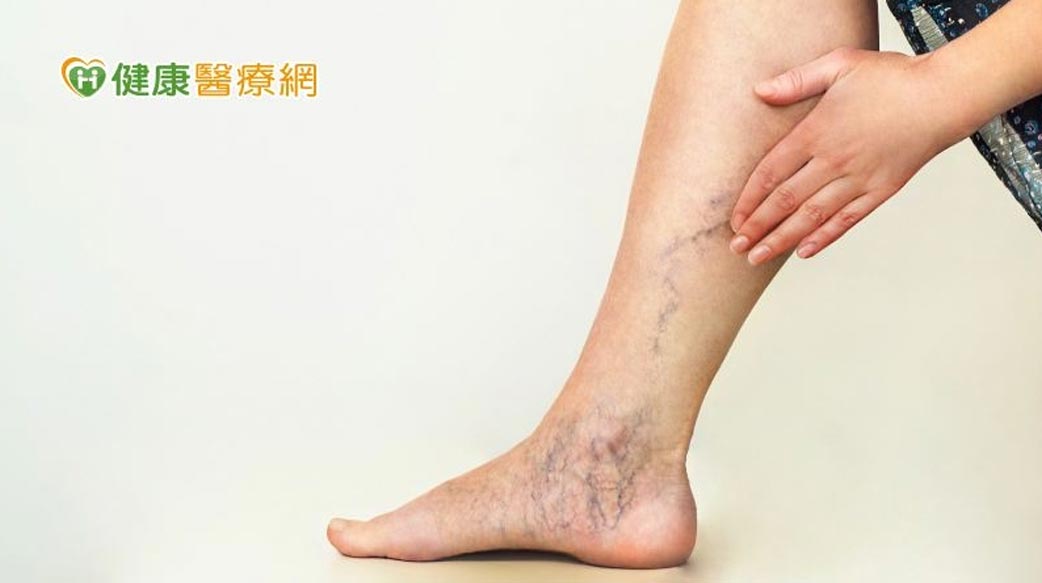 「這些人」易有靜脈曲張　如何預防、緩解症狀？醫師傳授抬腳、按摩方法