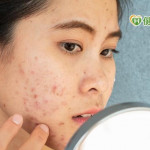 吃藥擔心副作用？療痘「心」選擇，擁有健康肌膚不是夢！