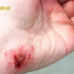 「液體OK繃」成分曝光　食藥署囑：1族群當心嚴重副作用