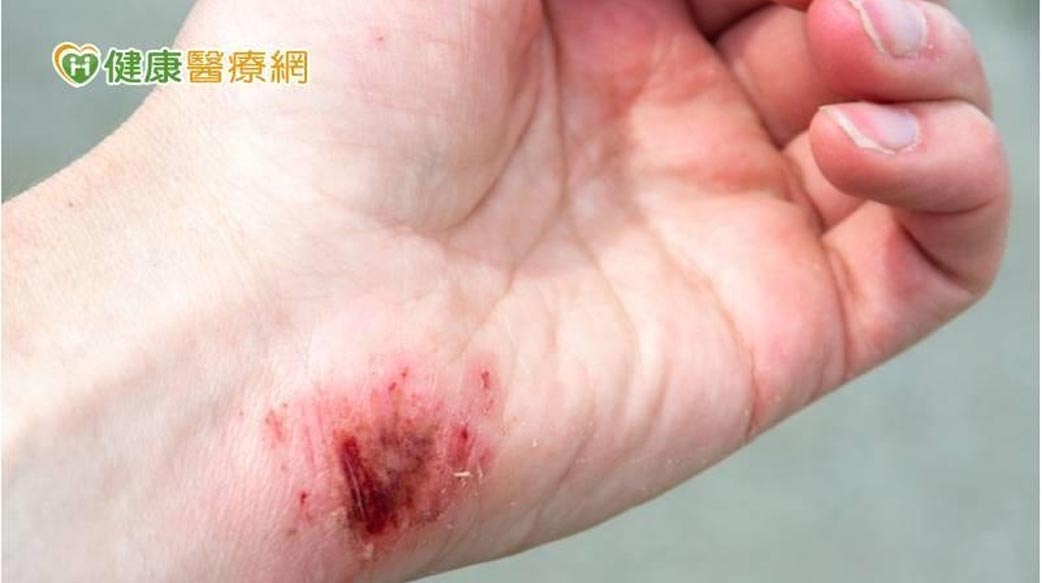 「液體OK繃」成分曝光　食藥署囑：1族群當心嚴重副作用