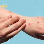 結節性癢疹「神經發炎」1顆癢全身！　研究曝治療新利器可有效改善