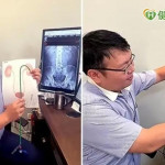 腎結石治療　8公分結石也能如吸塵器般「吸」除