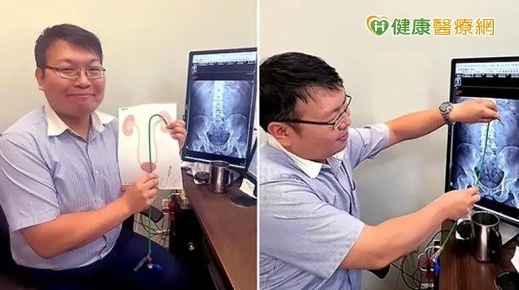 腎結石治療　8公分結石也能如吸塵器般「吸」除