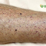 「免疫性血小板缺乏紫斑症」治療一年卻無效？　竟是鈣片惹禍！