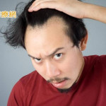 找回頂上風光　對抗雄性禿元凶「DHT」治療攻略