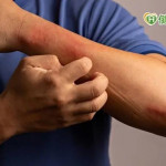 異位性皮膚炎搔抓皮膚爛！　醫建議「日常這樣做」有效控病情