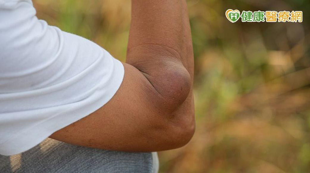 脂肪瘤不只是肥胖者專利！中醫提醒可能與壓力、飲食有關