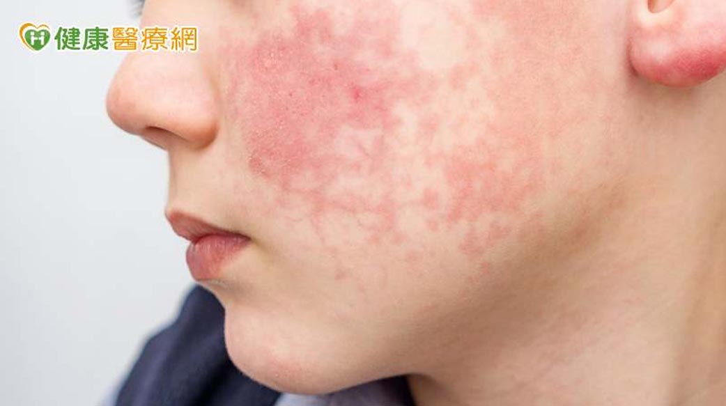 赴日前必知！「蘋果病」究竟是什麼？症狀、預防方式一次看