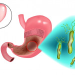 别轻忽幽门螺旋杆菌感染，恐会得胃癌