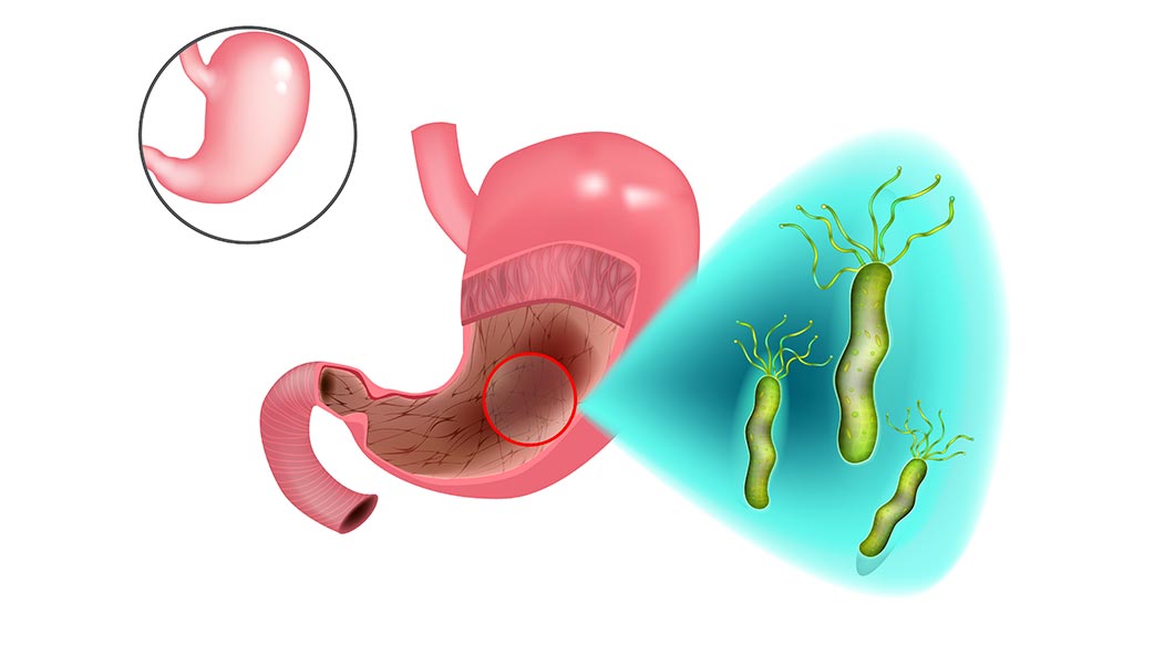 别轻忽幽门螺旋杆菌感染，恐会得胃癌