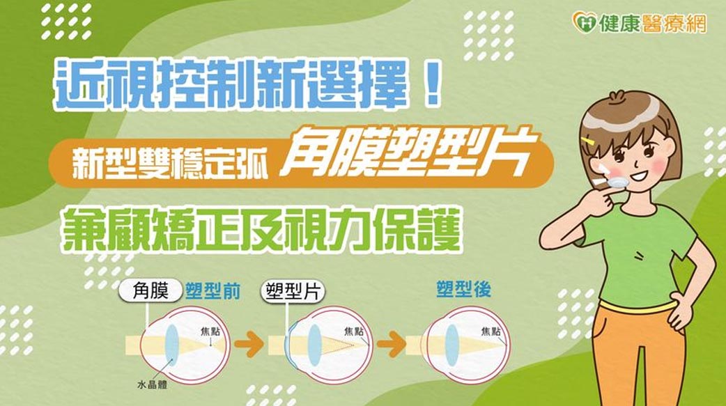 近視控制新選擇！新型雙穩定弧角膜塑型片兼顧矯正及視力保護