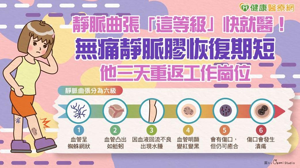 靜脈曲張「這等級」快就醫！無痛靜脈膠恢復期短　他三天重返工作崗位