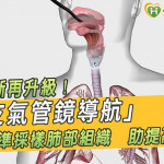 肺癌診斷再升級！「AI支氣管鏡導航」精準採樣肺部組織　助提高診斷率