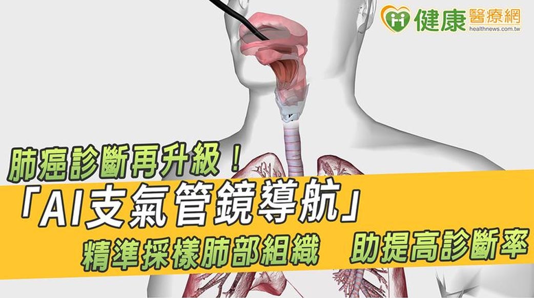 肺癌診斷再升級！「AI支氣管鏡導航」精準採樣肺部組織　助提高診斷率