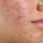 開學遇上滿臉痘痘不敢見同學？醫師教你和孩子如何對抗惱人青春痘