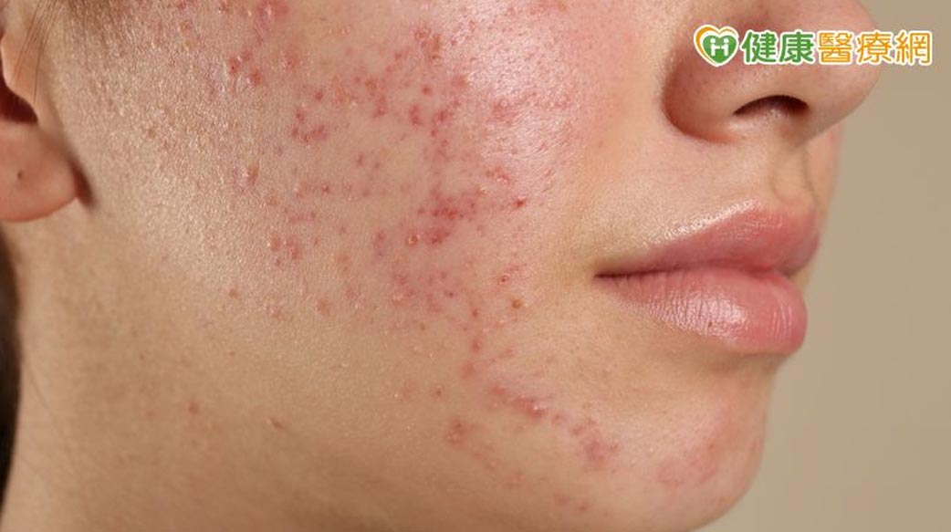開學遇上滿臉痘痘不敢見同學？醫師教你和孩子如何對抗惱人青春痘