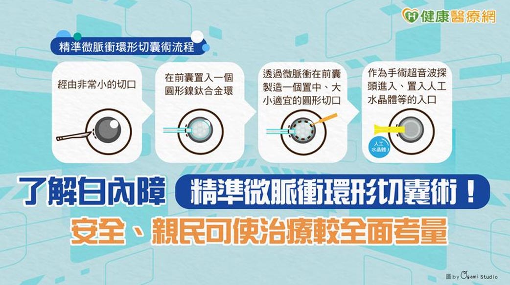 了解白內障「精準微脈衝環形切囊術」！　安全、親民可使治療較全面考量